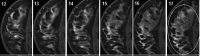 Breast lesion segmentation original series